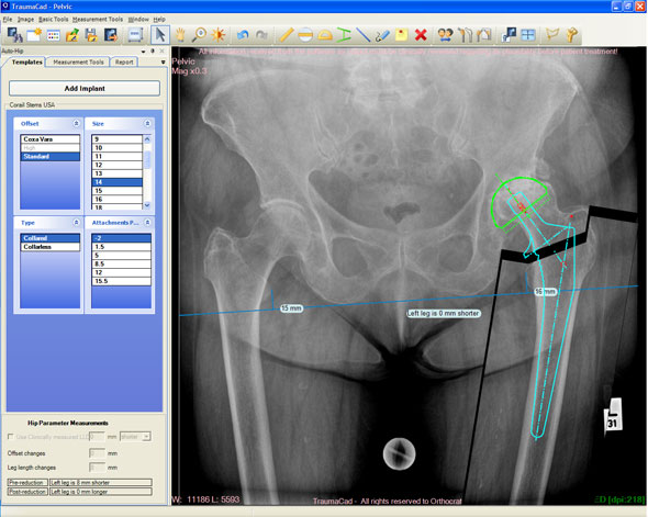 Auto-Hip Procedure